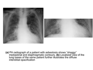 (a) PA radiograph of a patient with asbestosis shows “shaggy”
mediastinal and diaphragmatic contours, (b) Localized view of the
lung bases of the same patient further illustrates the diffuse
interstitial opacification
 