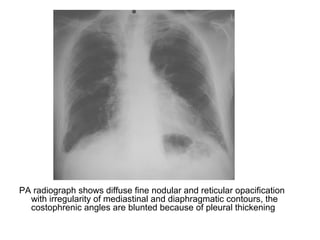 PA radiograph shows diffuse fine nodular and reticular opacification
with irregularity of mediastinal and diaphragmatic contours, the
costophrenic angles are blunted because of pleural thickening
 