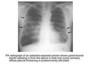 PA radiograph of an asbestos-exposed person shows parenchymal
bands radiating in from the pleura in both mid zones (arrows),
diffuse pleural thickening is predominantly left-sided
 