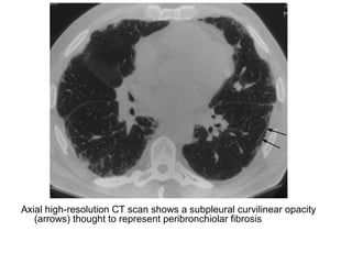 Axial high-resolution CT scan shows a subpleural curvilinear opacity
(arrows) thought to represent peribronchiolar fibrosis
 