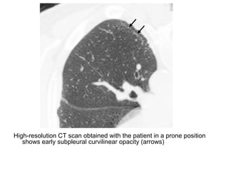 High-resolution CT scan obtained with the patient in a prone position
shows early subpleural curvilinear opacity (arrows)
 