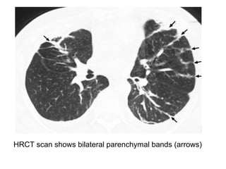 HRCT scan shows bilateral parenchymal bands (arrows)
 