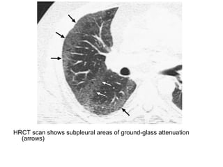 HRCT scan shows subpleural areas of ground-glass attenuation
(arrows)
 