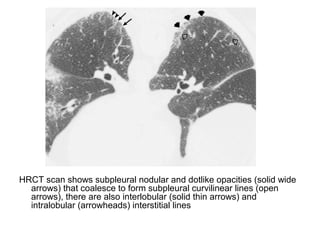 HRCT scan shows subpleural nodular and dotlike opacities (solid wide
arrows) that coalesce to form subpleural curvilinear lines (open
arrows), there are also interlobular (solid thin arrows) and
intralobular (arrowheads) interstitial lines
 