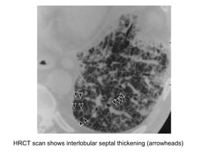 HRCT scan shows interlobular septal thickening (arrowheads)
 