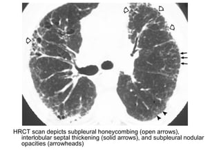 HRCT scan depicts subpleural honeycombing (open arrows),
interlobular septal thickening (solid arrows), and subpleural nodular
opacities (arrowheads)
 