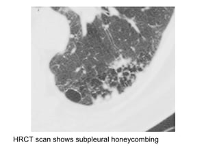 HRCT scan shows subpleural honeycombing
 