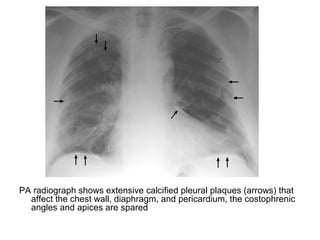 PA radiograph shows extensive calcified pleural plaques (arrows) that
affect the chest wall, diaphragm, and pericardium, the costophrenic
angles and apices are spared
 