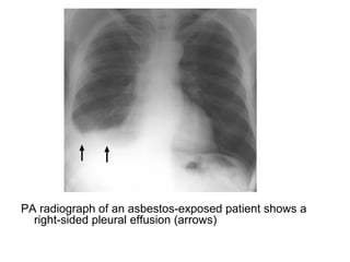 PA radiograph of an asbestos-exposed patient shows a
right-sided pleural effusion (arrows)
 