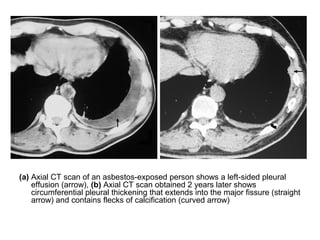 (a) Axial CT scan of an asbestos-exposed person shows a left-sided pleural
effusion (arrow), (b) Axial CT scan obtained 2 years later shows
circumferential pleural thickening that extends into the major fissure (straight
arrow) and contains flecks of calcification (curved arrow)
 
