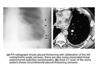 (a) PA radiograph shows pleural thickening with obliteration of the left
costophrenic angle (arrows), there are also some associated linear
parenchymal opacities (arrowheads), (b) Axial CT scan of the same
patient shows circumferential pleural thickening (arrows)
 
