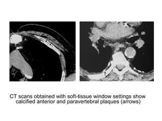 CT scans obtained with soft-tissue window settings show
calcified anterior and paravertebral plaques (arrows)
 