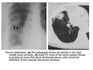 Round atelectasis, (a) PA radiograph shows an opacity in the right
middle zone (arrows), (b) Axial CT scan of the same patient shows
a peripheral mass that abuts thickened pleura, with comet tail
distortion of the vascular structures (arrows)
 