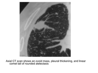 Axial CT scan shows an ovoid mass, pleural thickening, and linear
comet tail of rounded atelectasis
 