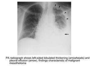 PA radiograph shows left-sided lobulated thickening (arrowheads) and
pleural effusion (arrow), findings characteristic of malignant
mesothelioma
 