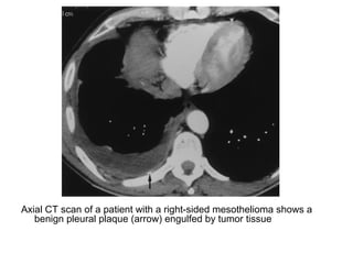 Axial CT scan of a patient with a right-sided mesothelioma shows a
benign pleural plaque (arrow) engulfed by tumor tissue
 