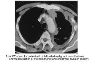 Axial CT scan of a patient with a left-sided malignant mesothelioma
shows contraction of the hemithorax and chest wall invasion (arrow)
 