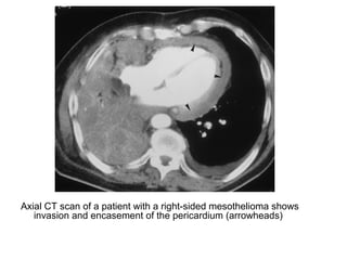 Axial CT scan of a patient with a right-sided mesothelioma shows
invasion and encasement of the pericardium (arrowheads)
 