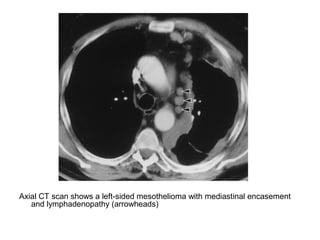 Axial CT scan shows a left-sided mesothelioma with mediastinal encasement
and lymphadenopathy (arrowheads)
 