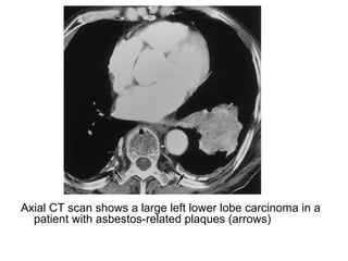 Axial CT scan shows a large left lower lobe carcinoma in a
patient with asbestos-related plaques (arrows)
 