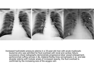 Increased hydrostatic pressure edema in a 33-year-old man with acute myelocytic
leukemia who was admitted for fluid overload with renal and cardiac failure,
successive chest radiographs demonstrate progressive lobar vessel enlargement,
peribronchial cuffing (arrows in b), bilateral Kerley lines (arrowheads in c), and late
alveolar edema with nodular areas of increased opacity, the fluid overload is
confirmed by the increasing size of the azygos vein
 