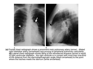 (a) Frontal chest radiograph shows a prominent main pulmonary artery (arrow) , dilated
right interlobar artery (arrowhead) and pruning of peripheral pulmonary vascularity ,
(b) Lateral chest radiograph shows filling of the retrosternal airspace (arrow) a result
of right ventricular dilatation , the right ventricle is in contact with more than one-third
of the distance from the sternodiaphragmatic angle (black arrowhead) to the point
where the trachea meets the sternum (white arrowhead)
 