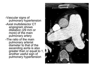 -Vascular signs of
pulmonary hypertension
-Axial multidetector CT
angiogram shows
dilatation (29 mm or
more) of the main
pulmonary artery
-The ratio of the main
pulmonary arterial
diameter to that of the
ascending aorta is also
greater than or equal to 1,
another useful sign of
pulmonary hypertension
 