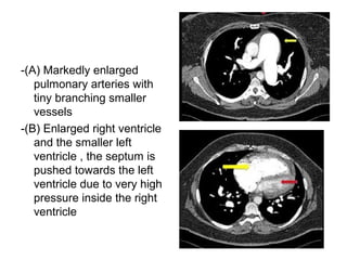 -(A) Markedly enlarged
pulmonary arteries with
tiny branching smaller
vessels
-(B) Enlarged right ventricle
and the smaller left
ventricle , the septum is
pushed towards the left
ventricle due to very high
pressure inside the right
ventricle
 