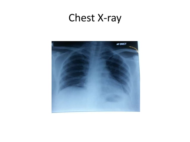 diffuse-peritonitis-ppt