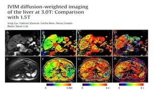 Diffusion Weighted MR from basic to advanced.pptx