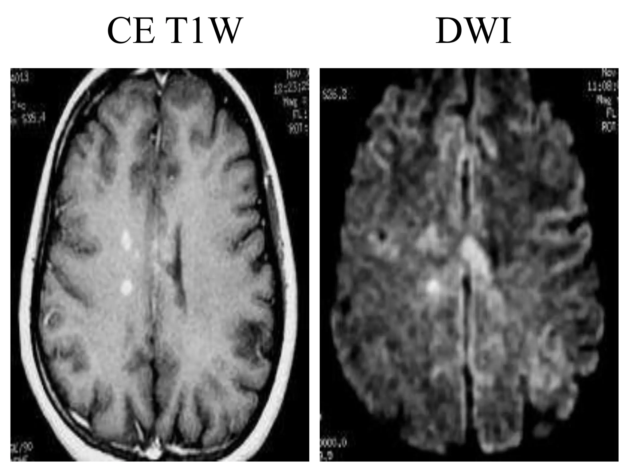 DIFFUSION & PERFUSION r MRI.ppt