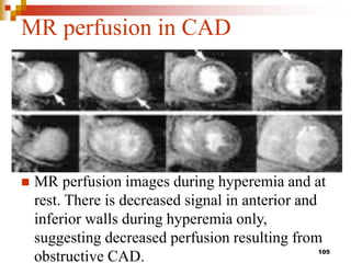 DIFFUSION  &   PERFUSION  r MRI.ppt