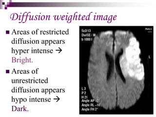 DIFFUSION  &   PERFUSION  r MRI.ppt