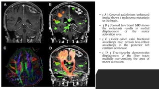 • ( A ) Coronal gadolinium-enhanced
image shows a melanoma metastasis
to the brain.
• ( B ) Coronal functional MRI shows
the metastasis results in medial
displacement of the motor
activation area.
• ( C ) Color-coded axial fractional
anisotropy map reveals less-robust
anisotropy in the posterior left
centrum semiovale.
• ( D ) Tractography demonstrates
displacement of the fiber tracts
medially surrounding the area of
motor activation.
 