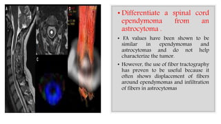 • Differentiate a spinal cord
ependymoma from an
astrocytoma .
• FA values have been shown to be
similar in ependymomas and
astrocytomas and do not help
characterize the tumor.
• However, the use of fiber tractography
has proven to be useful because it
often shows displacement of fibers
around ependymomas and infiltration
of fibers in astrocytomas
 