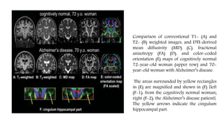 Comparison of conventional T1- (A) and
T2- (B) weighted images, and DTI-derived
mean diffusivity (MD) (C), fractional
anisotropy (FA) (D), and color-coded
orientation (E) maps of cognitively normal
72-year-old woman (upper row) and 70-
year-old woman with Alzheimer’s disease.
The areas surrounded by yellow rectangles
in (E) are magnified and shown in (F) [left
(F-1): from the cognitively normal woman;
right (F-2): the Alzheimer’s disease patient].
The yellow arrows indicate the cingulum
hippocampal part.
 