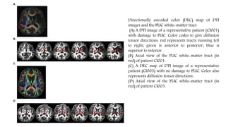 Directionally encoded color (DEC) map of DTI
images and the PLIC white-matter tract.
(A) A DTI image of a representative patient (CI001)
with damage to PLIC. Color codes to give diffusion
tensor directions: red represents tracts running left
to right; green is anterior to posterior; blue is
superior to inferior.
(B) Axial view of the PLIC white-matter tract (in
red) of patient CI001.
(C) A DEC map of DTI image of a representative
patient (CI003) with no damage to PLIC. Color also
represents diffusion tensor directions.
(D) Axial view of the PLIC white-matter tract (in
red) of patient CI003.
 