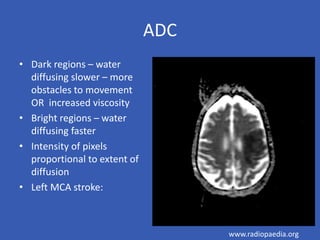 ADC
• Dark regions – water
diffusing slower – more
obstacles to movement
OR increased viscosity
• Bright regions – water
diffusing faster
• Intensity of pixels
proportional to extent of
diffusion
• Left MCA stroke:
www.radiopaedia.org
 