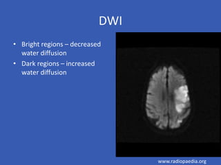 DWI
• Bright regions – decreased
water diffusion
• Dark regions – increased
water diffusion
www.radiopaedia.org
 
