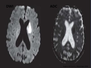 DWI ADC
Hygino da Cruz Jr, Neurology 2008
 