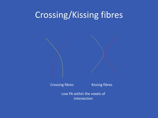Crossing/Kissing fibres
Crossing fibres Kissing fibres
Low FA within the voxels of
intersection
 