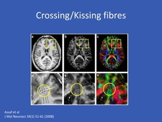 Crossing/Kissing fibres
Assaf et al
J Mol Neurosci 34(1) 51-61 (2008)
 