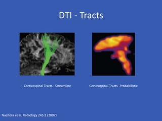 DTI - Tracts
Nucifora et al. Radiology 245:2 (2007)
Corticospinal Tracts -Probabilistic
Corticospinal Tracts - Streamline
 
