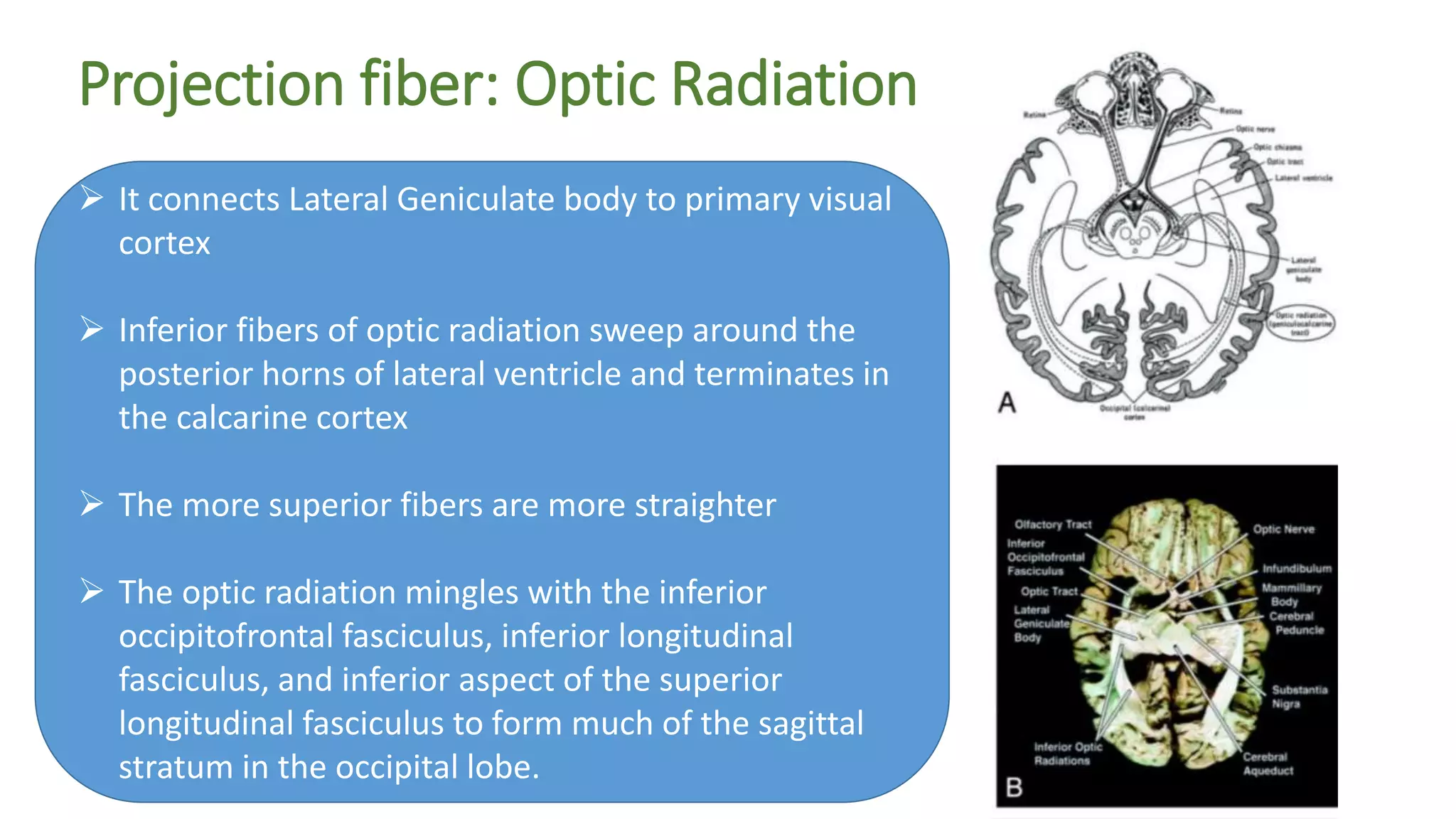 Projection fiber: Optic Radiation
 It connects Lateral Geniculate body to primary visual
cortex
 Inferior fibers of optic radiation sweep around the
posterior horns of lateral ventricle and terminates in
the calcarine cortex
 The more superior fibers are more straighter
 The optic radiation mingles with the inferior
occipitofrontal fasciculus, inferior longitudinal
fasciculus, and inferior aspect of the superior
longitudinal fasciculus to form much of the sagittal
stratum in the occipital lobe.
 