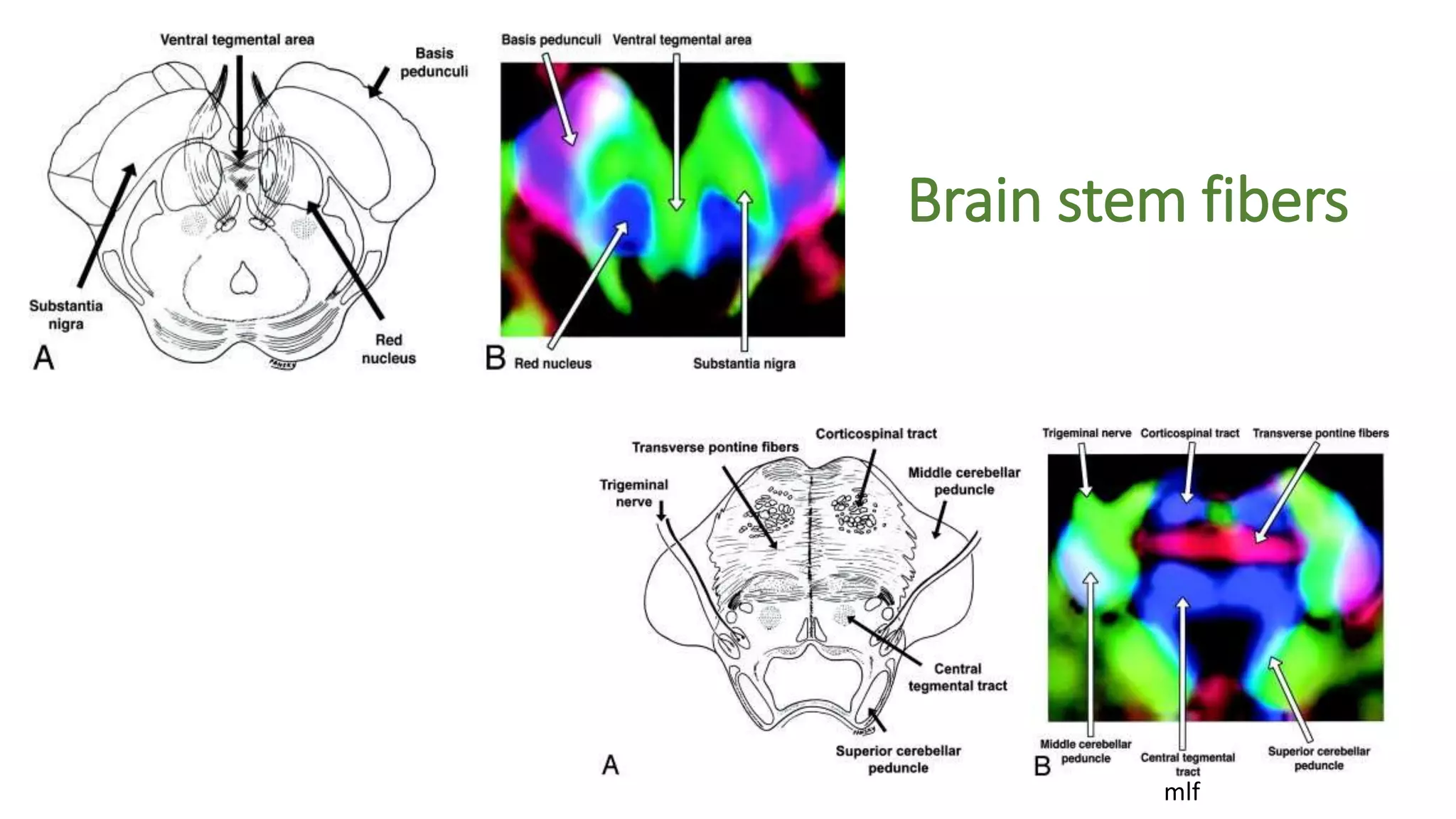 Brain stem fibers
mlf
 