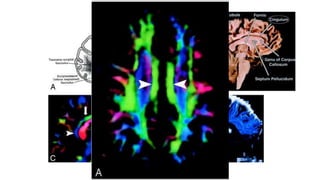 Diffusion tensor imaging .pptx