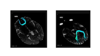 Diffusion tensor imaging .pptx