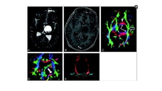 Diffusion tensor imaging .pptx