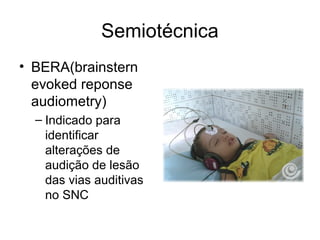 Semiotécnica 
• BERA(brainstern 
evoked reponse 
audiometry) 
– Indicado para 
identificar 
alterações de 
audição de lesão 
das vias auditivas 
no SNC 
 