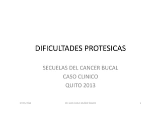 DIFICULTADES PROTESICAS
SECUELAS DEL CANCER BUCAL
CASO CLINICO
QUITO 2013
07/05/2014 1DR. GIAN CARLO MUÑOZ RAMOS
 